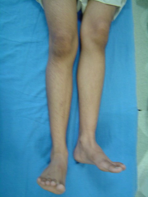 Short Leg Before Surgery